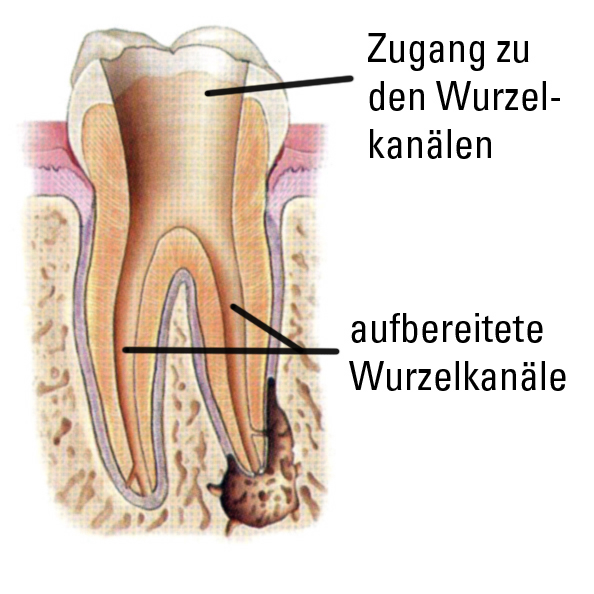 offener Zahn mit aufbereiteten Wurzelkanälen