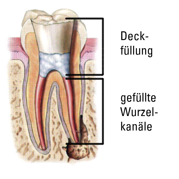 therapierter Zahn mit Füllung des Wurzelkanals