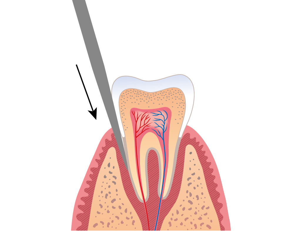Extraktion: Der Zahn wird mit einem Hebel leicht gelockert.